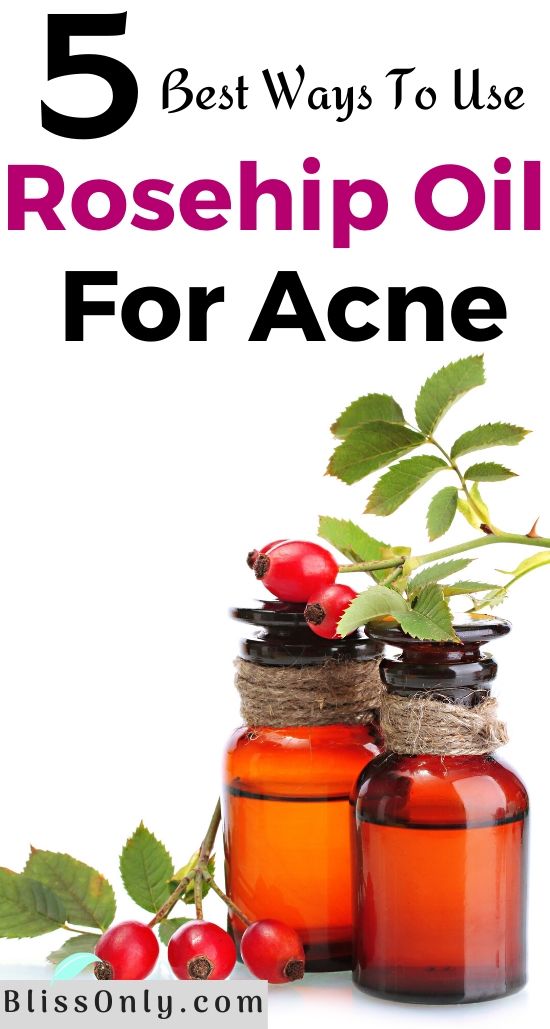 5 Best Ways To Use Rosehip Oil For Acne BlissOnly